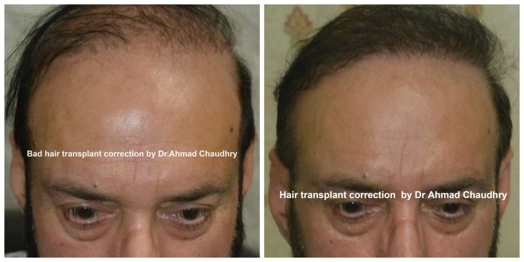 Bad hair transplant operation repair | Cosmoderma clinic Lahore Pakistan