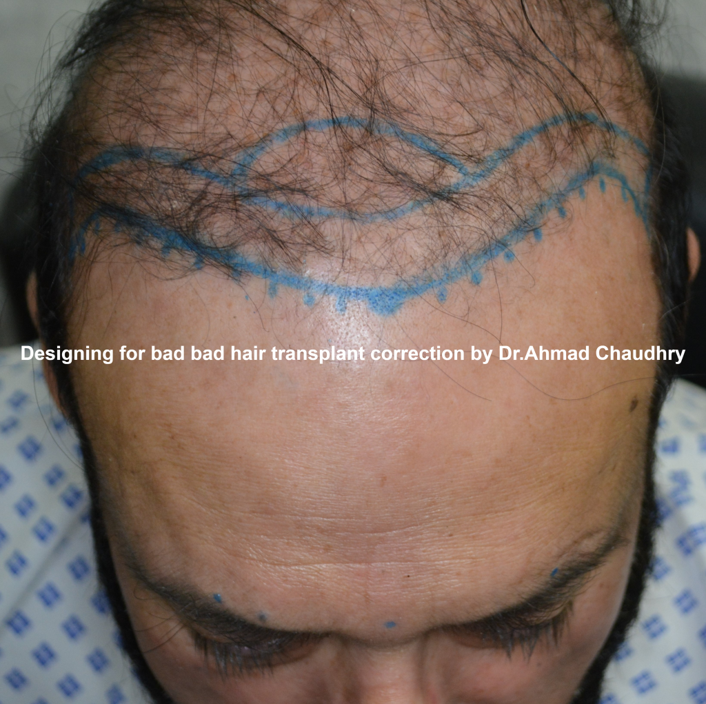 bad hair transplant repair clinic Lahore