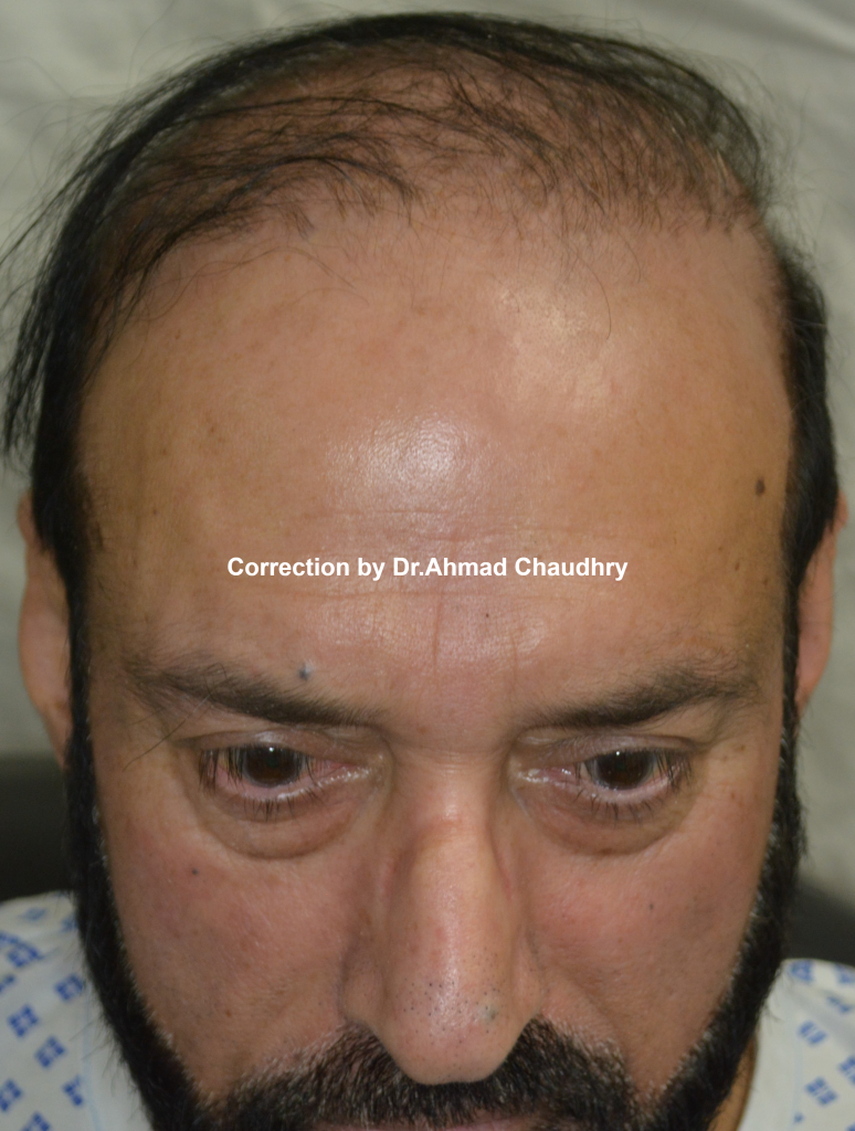 Repairing bad hair transplant Lahore