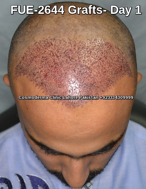 Post op hair transplant photo