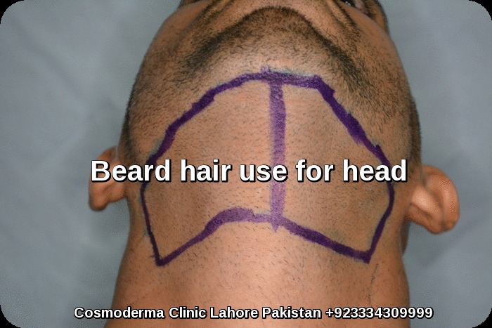 Beard donor area preparation 