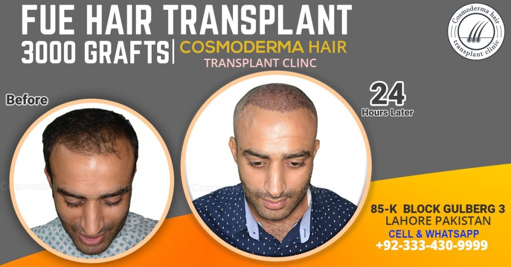 3000-grafts-hair-transplant-before-after-Lahore-Pakistan