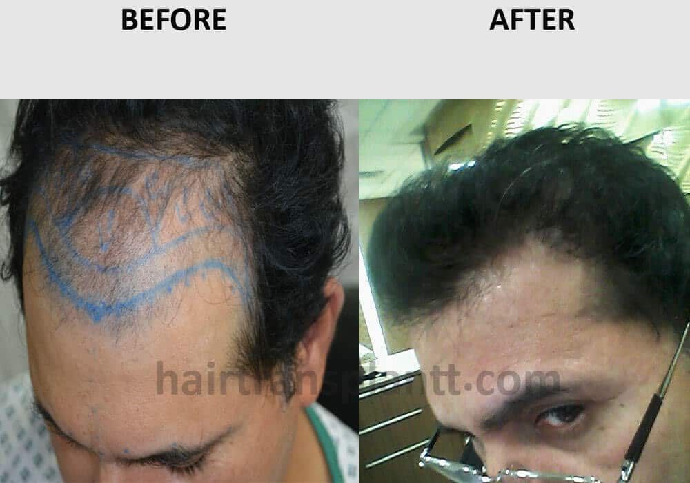 3000 grafts hair transplant before and after Lahore Pakistan