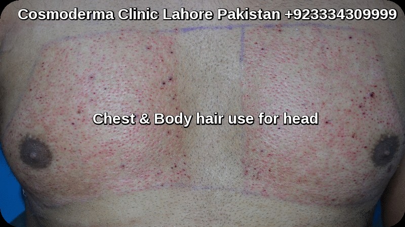 body hair transplant in Pakistan