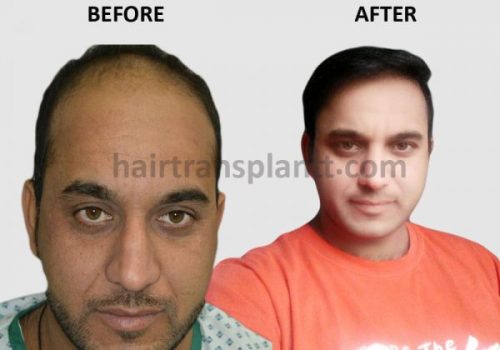 hair restoration Lahore