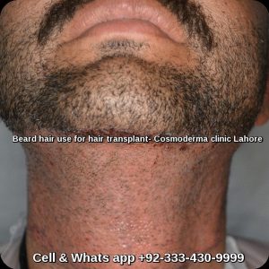 Beard-hair-use-for-hair-transplant-Lahore-Pakistan