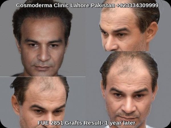 Best-hair-restoration-result-Lahore