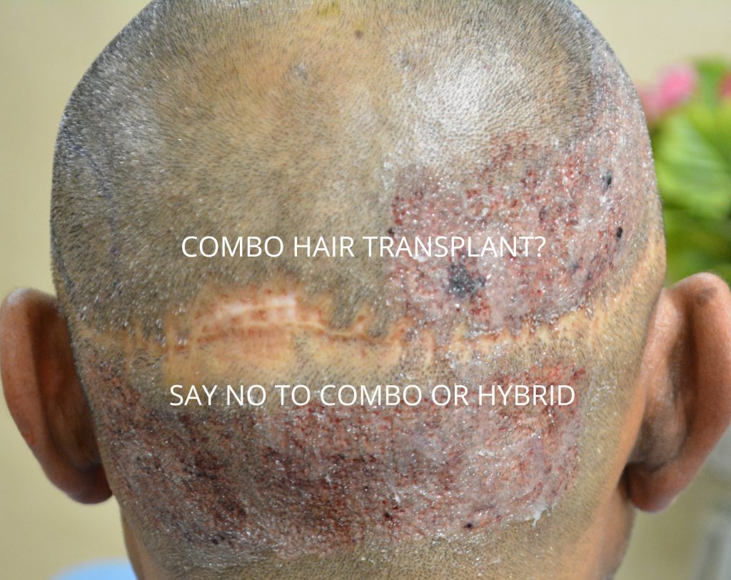 Combo-hybrid-hair-transplant