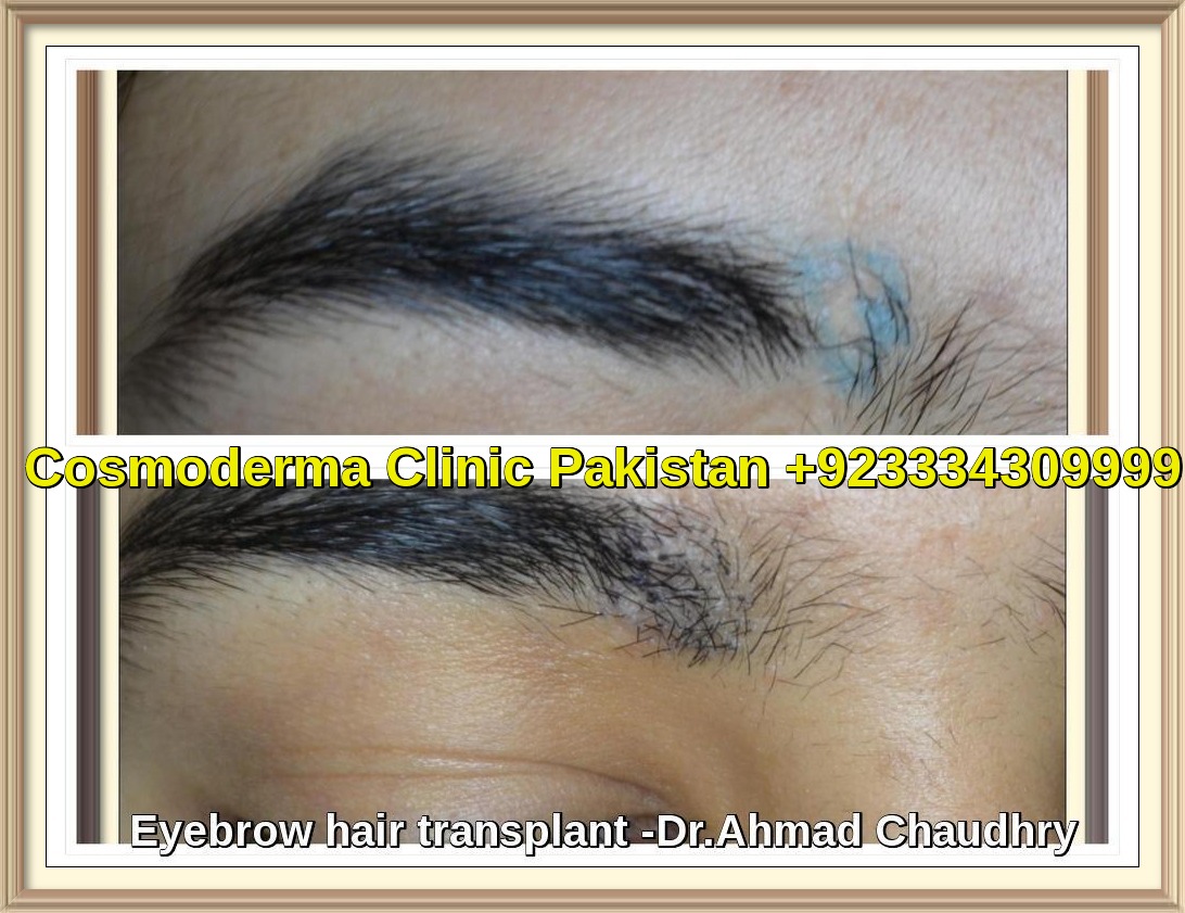 Eyebrow hair transplant Lahore Pakistan 