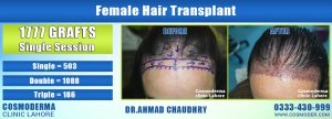 Female-hair-transplant-Lahore