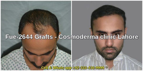 Fue-2644-grafts-hair-transplant-results-6-months-later-results-Lahore