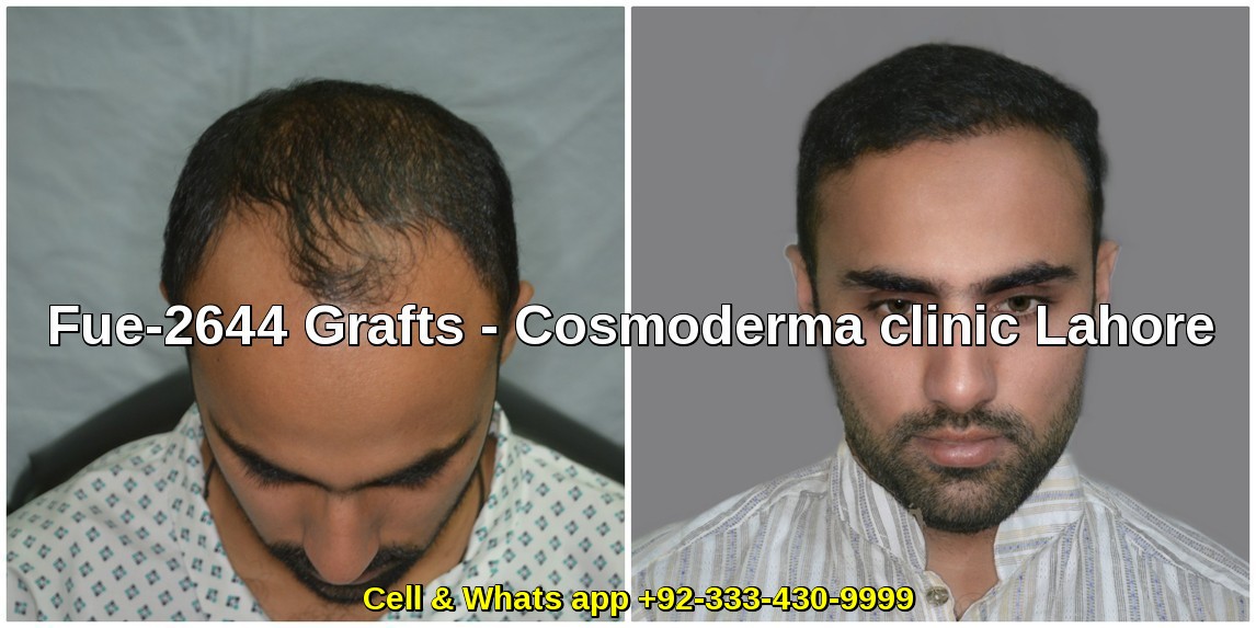 Dr Ahmad Chaudhry 2644 grafts six months results