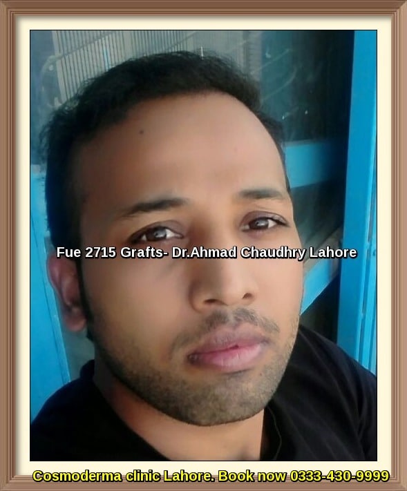 Fue-2715-grafts-hair-transplant-results-Lahore