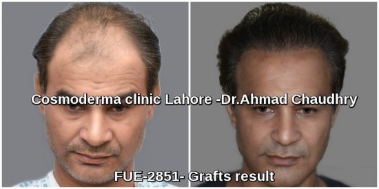 Fue-2851-grafts-hair-transplant-results-Lahore-Pakistan
