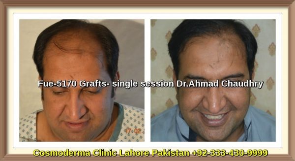 Fue-5170-grafts-hair-transplant-results-lahore-Pakistan