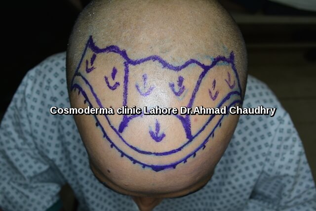 Front baldness area surgical marking
