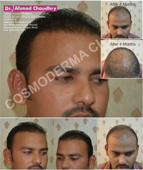 Treated Fue patient Lahore