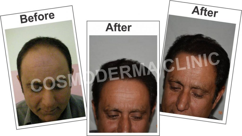 Hair-Restoration-in-Pakistan-Dr.Ahmad_
