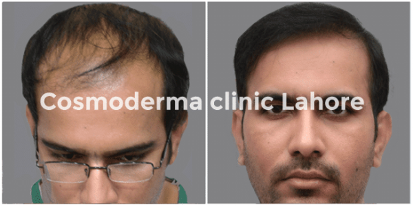 Hair-transplant-before-after01
