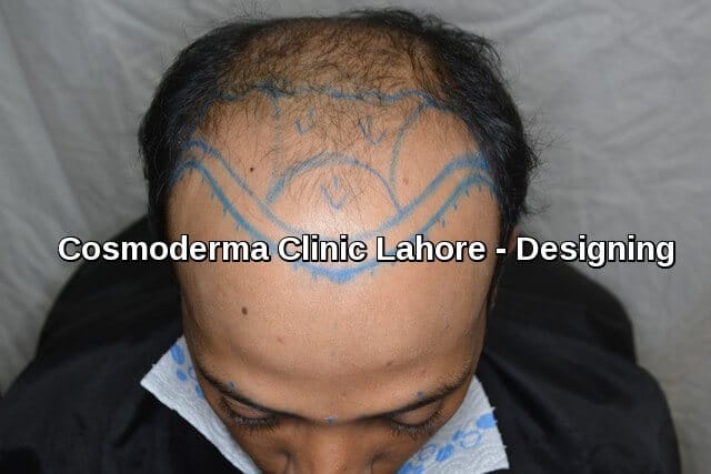 Hair-transplant-blue-pencil-marking-Lahore