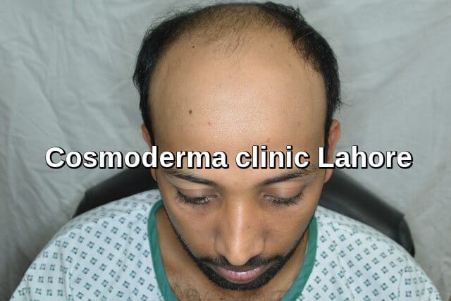 Fue hair transplant results Lahore