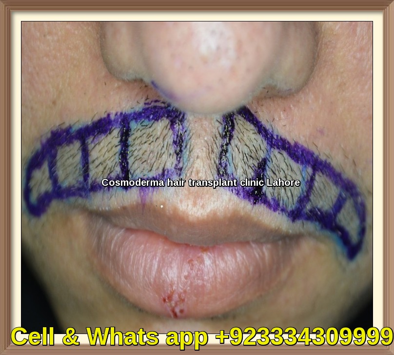 Mustache-hair-transplant-Lahore