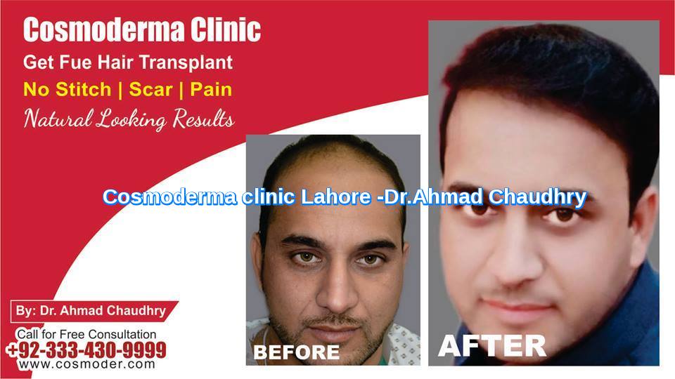 Realistic-expectations-after-FUE-hair-transplant