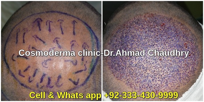 Crown hair transplant Lahore 