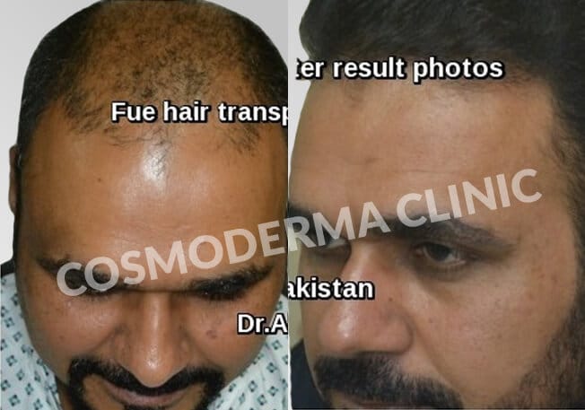 Fue hair transplant before and after results Lahore