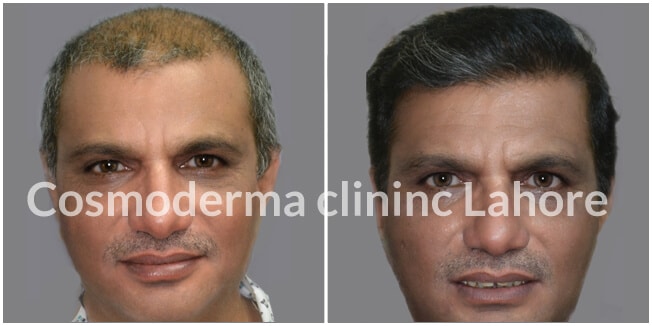 Hair transplant results cosmoderma clinic Lahore