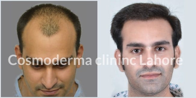 Best hair transplant results in Pakistan