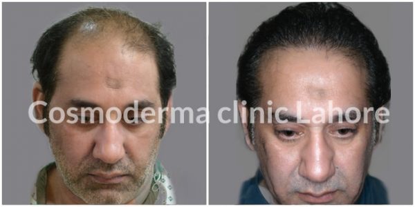 Hair transplant before and after Lahore