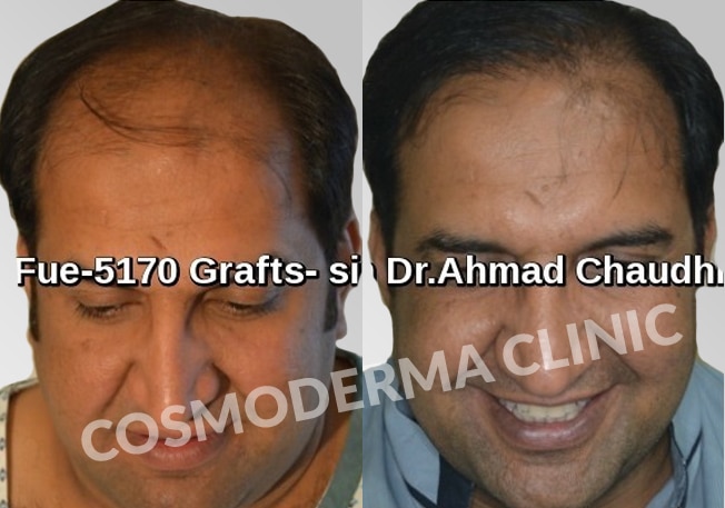 Fue 5170 grafts before after result Lahore