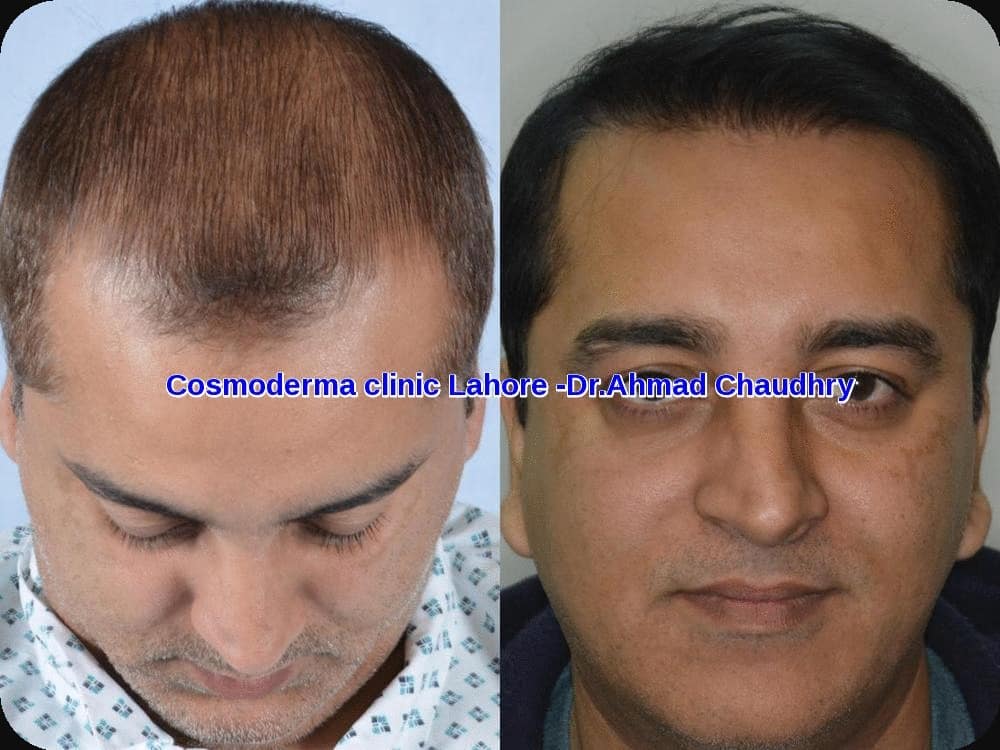 hair transplant before and after