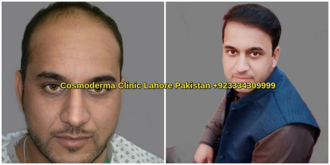 Hair transplant Photos with Thick Density