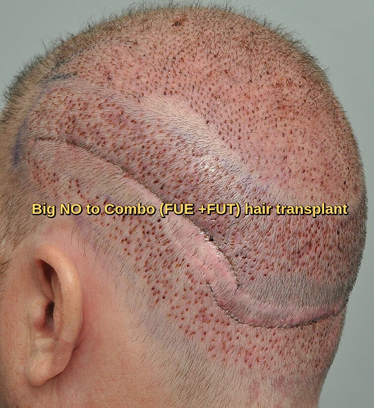 Hybrid Combo hair transplant