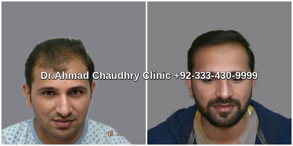 Best hair transplants in Lahore