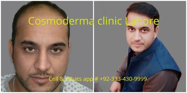 FUE 2900 grafts Cosmoderma clinic best hair surgeon Lahore