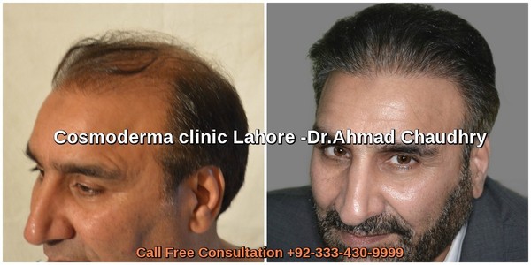 FUE 3000 grafts results Lahore