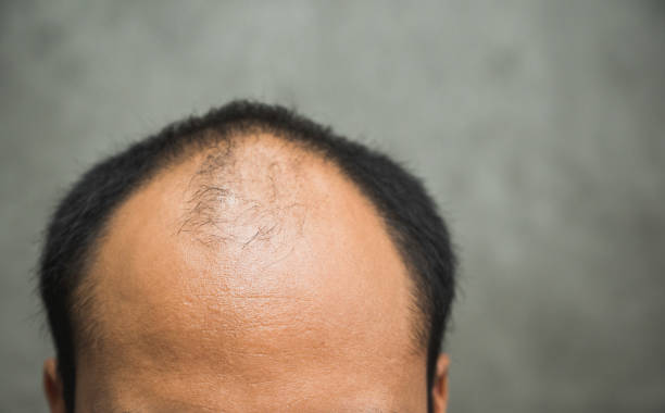 Frontal baldness