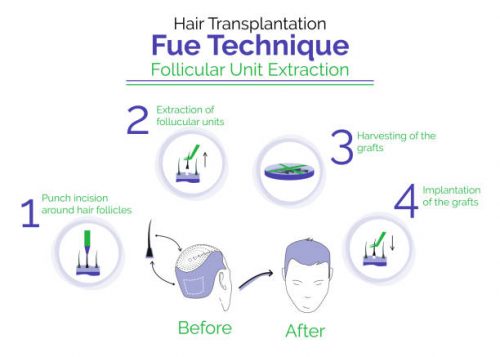Fue hair transplant technique Lahore