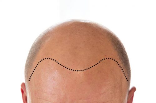 Why does male pattern baldness happen