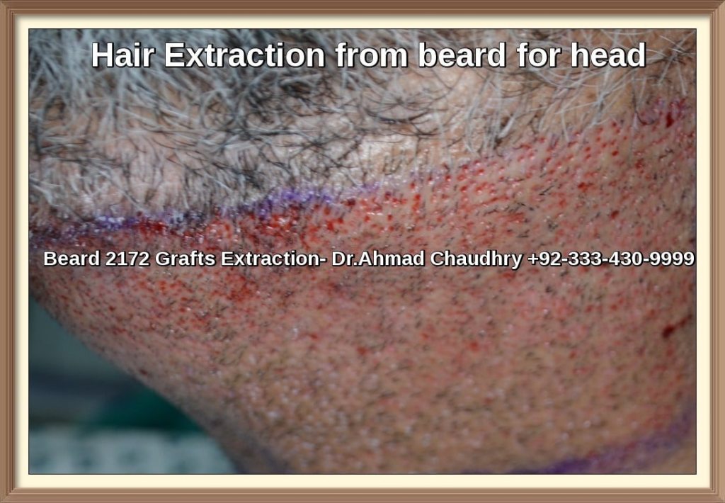 how many hairs are extracted from a beard