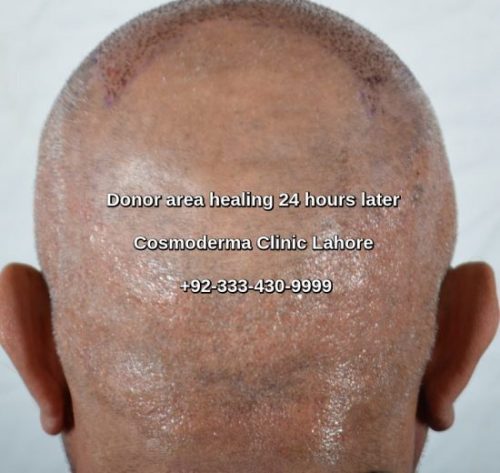 Fue hair transplant recovery donor area
