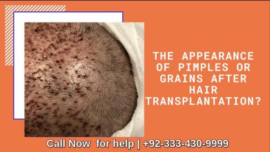 Pimples after hair transplant