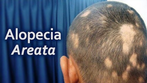 alopecia-areata-treatment -Lahore-Pakistan
