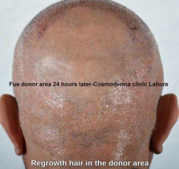 Follicles grow back after FUE hair transplant