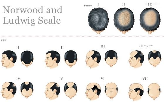 Male pattern baldness stages