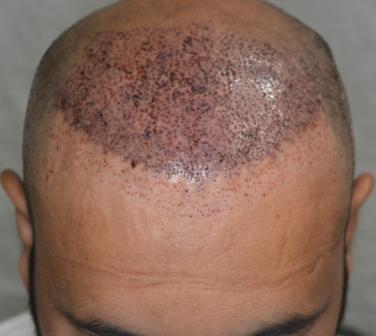 Redesign previous hair transplant