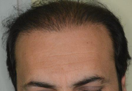 Redesigning previous hair transplant results